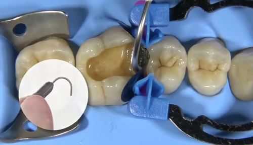 冶牙齿整个过程视频（给我看一下治牙的过程）-图3