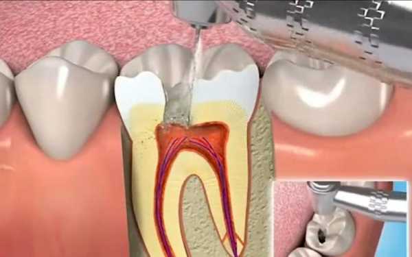 冶牙齿整个过程视频（给我看一下治牙的过程）-图1