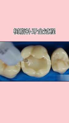补牙后带牙套的过程（补牙后带牙套需要多长时间）-图2
