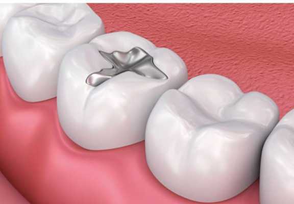 补牙后带牙套的过程（补牙后带牙套需要多长时间）-图1