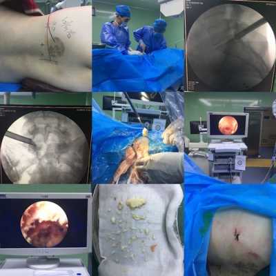 腰椎突出手术过程（腰椎突出手术过程视频）-图3