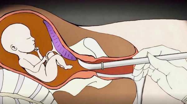 打胎手术视频全过程（打胎的手术过程）-图2