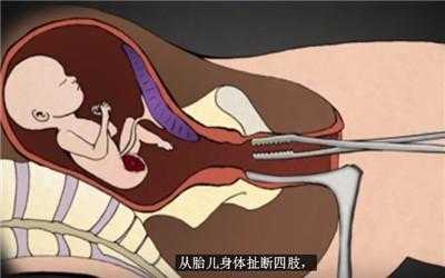 打胎手术视频全过程（打胎的手术过程）-图3
