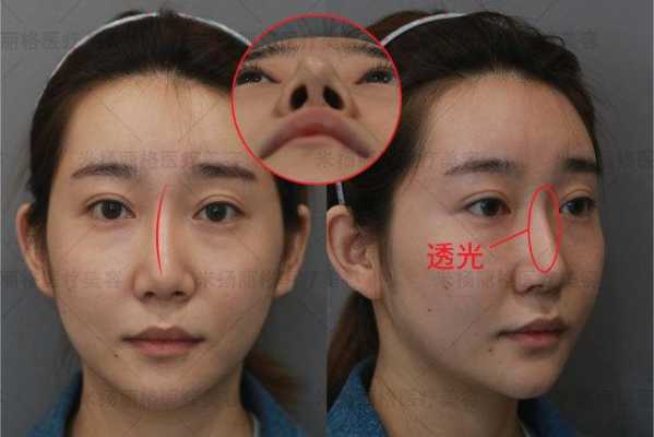 隆鼻恢复全过程图片（隆鼻的恢复期是多久）-图1
