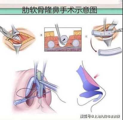 隆鼻恢复全过程图片（隆鼻的恢复期是多久）-图2