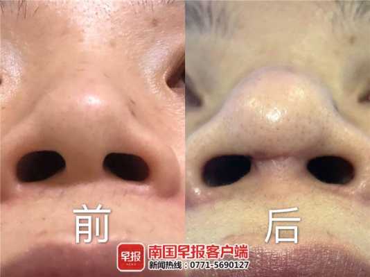 隆鼻恢复全过程图片（隆鼻的恢复期是多久）-图3