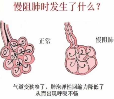 肺气肿的发展过程（肺气肿的发展过程图）-图2