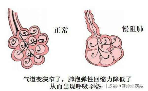 肺气肿的发展过程（肺气肿的发展过程图）-图3