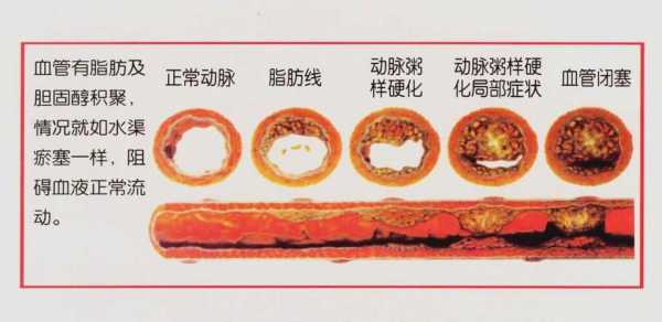 斑块形成过程（动脉粥样硬化斑块形成过程）-图1