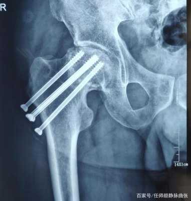 骨股颈骨折恢复过程（骨股颈骨折恢复过程踩地板疼）-图1