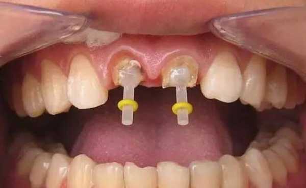 钻牙的视频过程（钻牙视频全过程）-图3