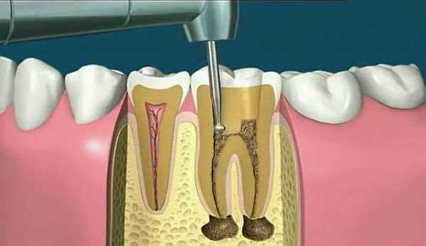 钻牙的视频过程（钻牙视频全过程）-图2