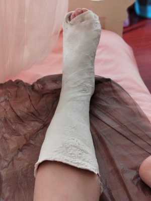 美女脚骨折打石膏过程（美女脚踝骨折打石膏）-图3