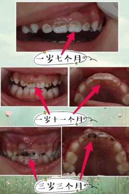 牙齿龋坏过程的图片（牙齿龋坏发展过程图片）-图1