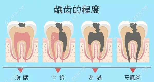牙齿龋坏过程的图片（牙齿龋坏发展过程图片）-图3