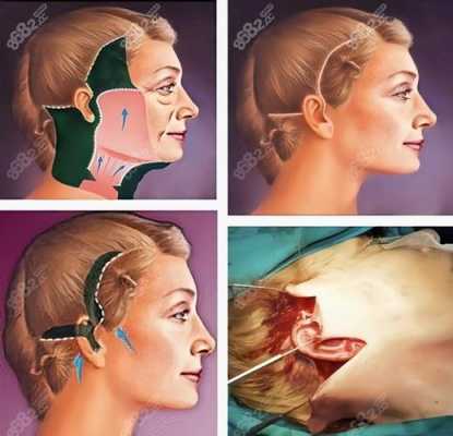 脸部拉皮手术过程图片（脸部拉皮手术过程图片真实）-图3