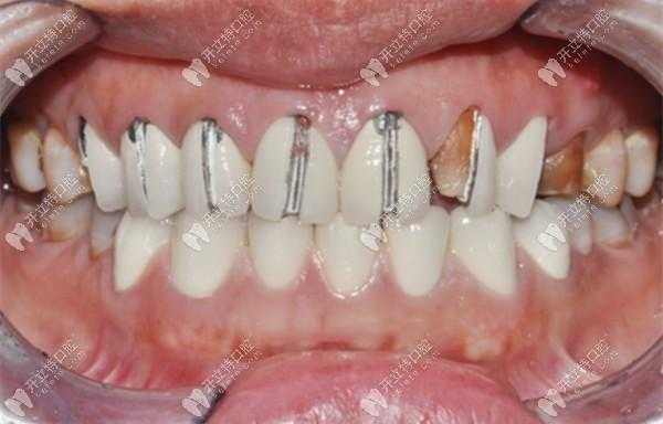 拆全瓷牙过程（拆全瓷牙过程需要多久）-图2