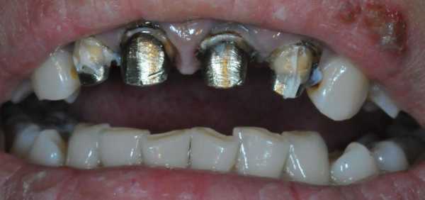拆全瓷牙过程（拆全瓷牙过程需要多久）-图3