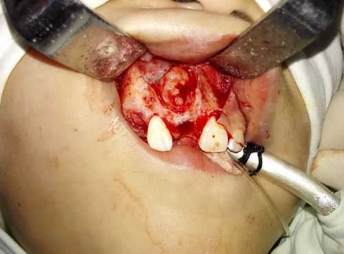 牙龈瘤手术过程（牙龈瘤手术过程难受不）-图3