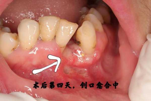 牙龈瘤手术过程（牙龈瘤手术过程难受不）-图2