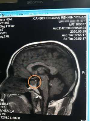 核磁共振检查过程（儿童垂体核磁共振检查过程）-图2