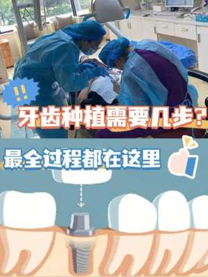 种植牙的真实过程（种植牙的真实过程图片）-图2
