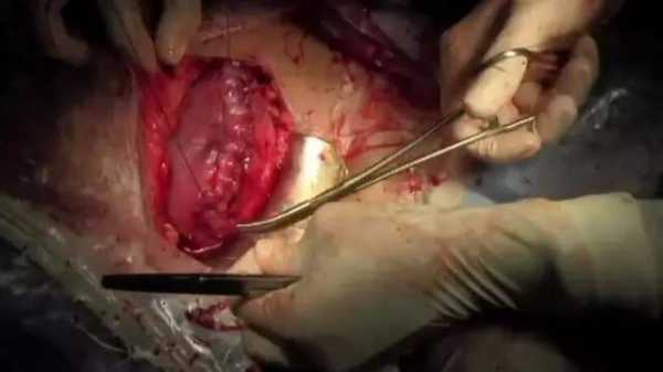 刨宫产视频过程高清（剖宫产视频大全）-图1