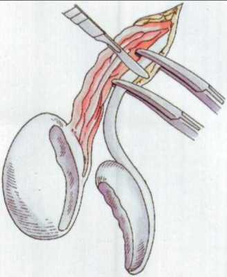 附睾手术过程图片（附睾手术过程图片大全）-图2