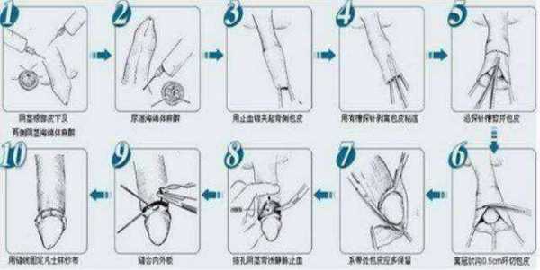 包皮套环术过程（包皮套环手术过程）-图3