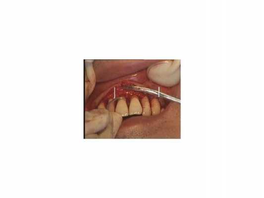 牙龈切除术过程（牙龈切除术有什么副作用）-图2