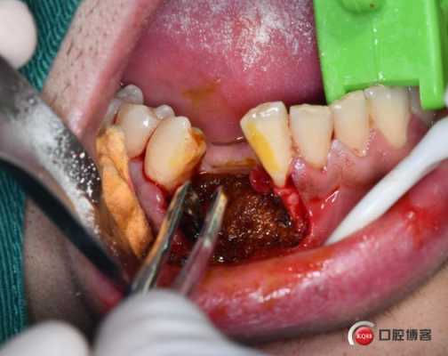 牙龈切除术过程（牙龈切除术有什么副作用）-图3