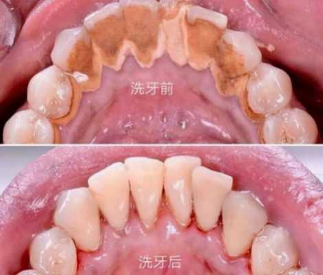 洗牙过程多久（洗牙要多久才能好）-图2