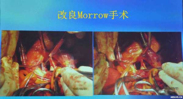morrow术过程（morrow手术）-图1