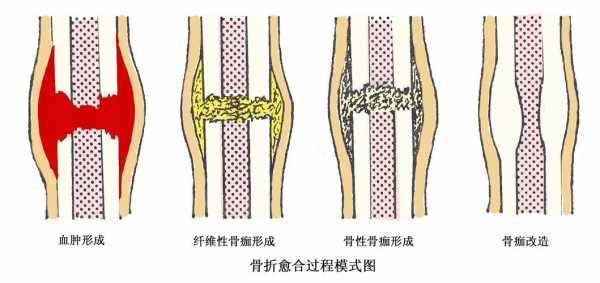 简述骨折愈合的过程（骨折愈合分期四个阶段）-图3