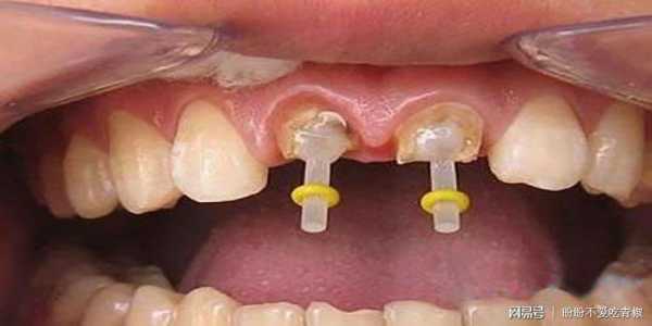 牙齿打桩的过程（牙齿打桩操作流程）-图1