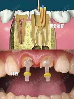 牙齿打桩的过程（牙齿打桩操作流程）-图2