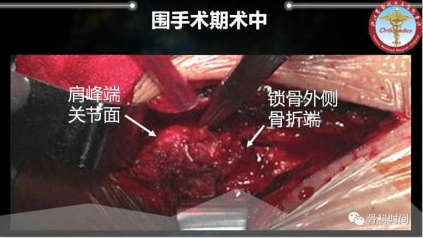 锁骨开刀过程（锁骨手术全过程视频）-图3