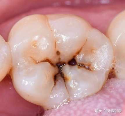 补牙烂神经的过程（补牙烂神经的药有毒吗）-图3