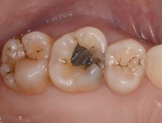 补牙烂神经的过程（补牙烂神经的药有毒吗）-图2