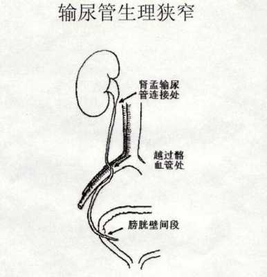 输尿管插管的过程（输尿插管的主要目的和作用）-图2