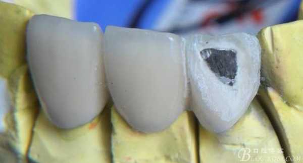 拆除金属烤瓷牙的过程（拆除金属烤瓷牙的过程图）-图3