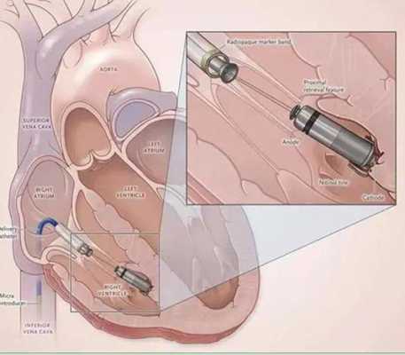 心脏起搏器植入过程（心脏起搏器植入过程视频）-图2