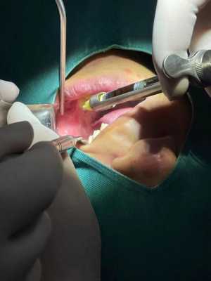 牙瘤手术过程（牙瘤做手术）-图2