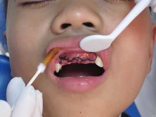牙瘤手术过程（牙瘤做手术）-图3