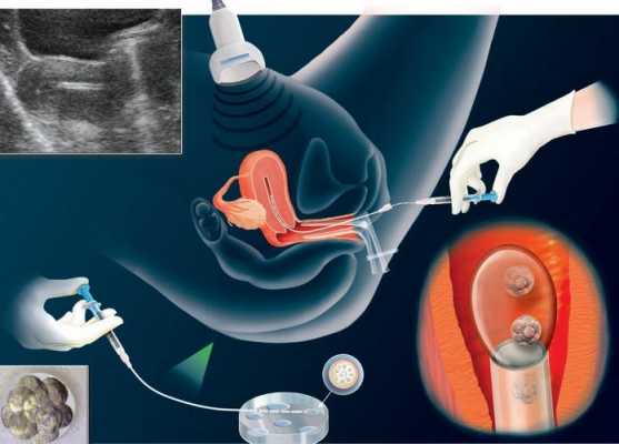 试管婴儿胚胎植入过程（试管婴儿胚胎植入过程视频）-图2