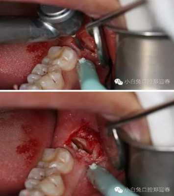 拔牙创骨愈合过程（拔牙创骨愈合过程图片）-图1