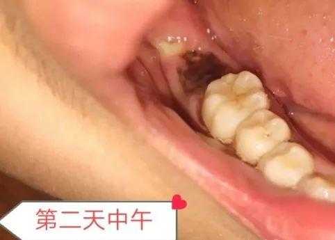 拔牙创骨愈合过程（拔牙创骨愈合过程图片）-图2
