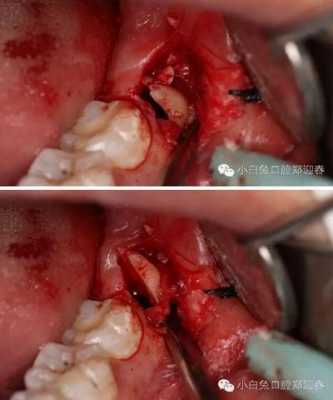 拔牙创骨愈合过程（拔牙创骨愈合过程图片）-图3