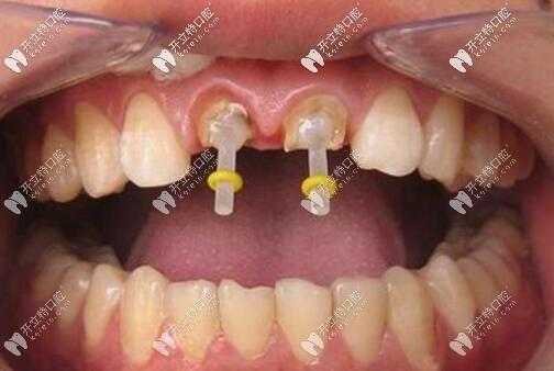 做牙套的过程（根管治疗后做牙套的过程）-图3
