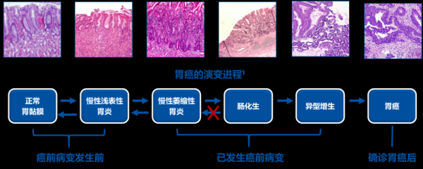 胃癌演变过程（胃癌演变过程需要多久）-图2